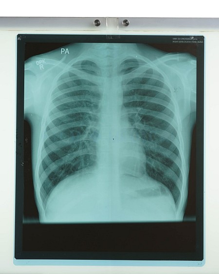 X-Ray Chest