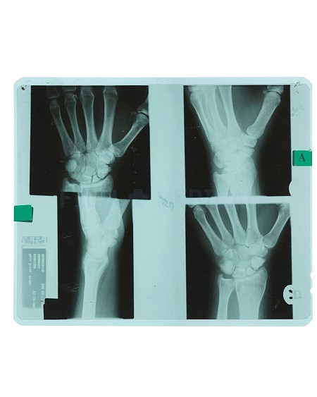 X-Ray Hand