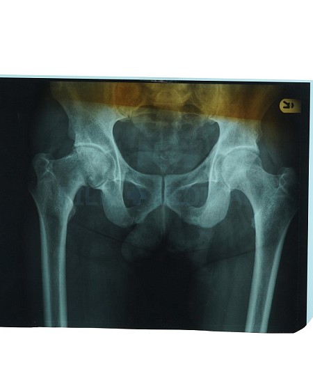 X-Ray Pelvis