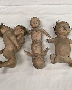 Conjoined babies and thalidomide baby