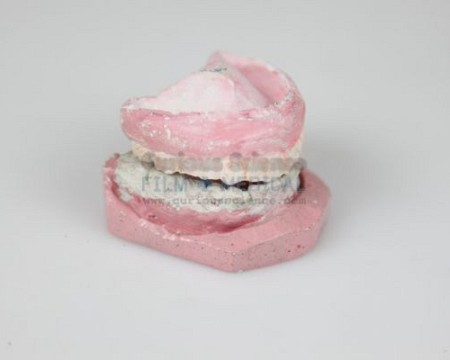 Denture Cast