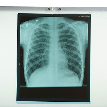X-Ray Chest