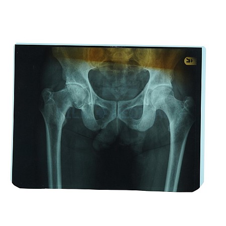 X-Ray Pelvis