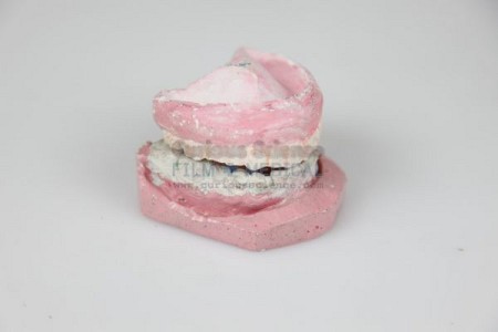 Denture Cast